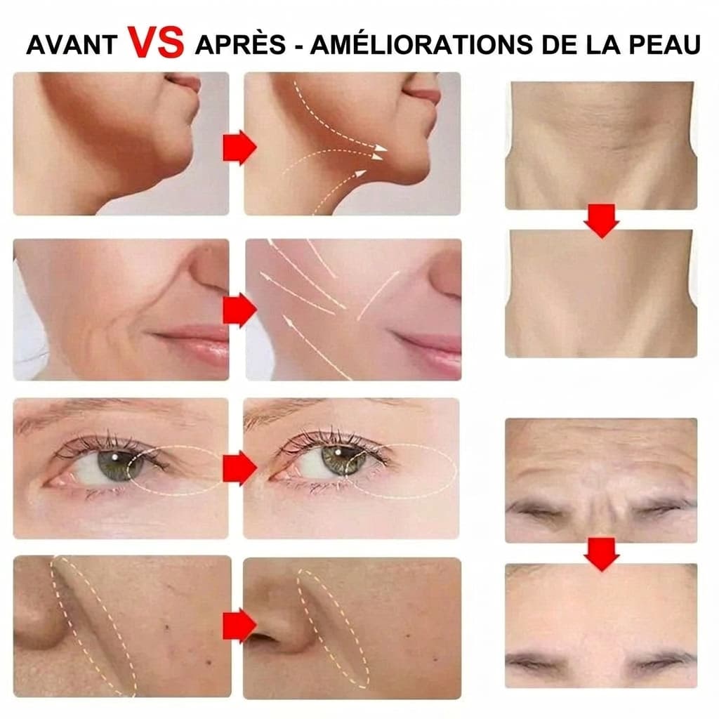 UltraSkin Lift™ Appareil à ultrasons HIFU portable - VEIGGARA